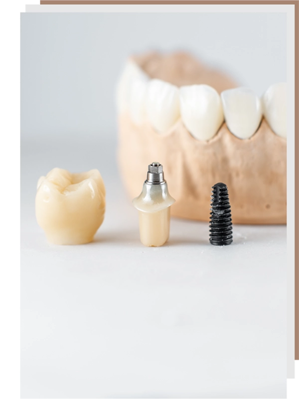 HB Dental Clinic Treatment Dental Implant